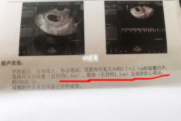 胎心胎芽是什么样的,胎儿胎心胎芽出现时间 第2张 胎心胎芽是什么样的,胎儿胎心胎芽出现时间 第2张