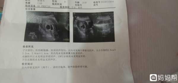 什么造成胎儿没有胎心(什么造成胎儿没有胎心胎芽) 第2张 什么造成胎儿没有胎心(什么造成胎儿没有胎心胎芽) 第2张