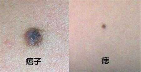怀孕期间长痣(怀孕期间长痣什么原因) 第2张 怀孕期间长痣(怀孕期间长痣什么原因) 第2张