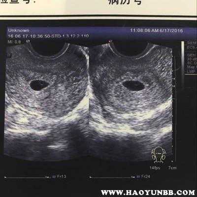 请问怀孕41天了,没有孕期反应,正常吗,孕期没反应说明什么 第1张 请问怀孕41天了,没有孕期反应,正常吗,孕期没反应说明什么 第1张