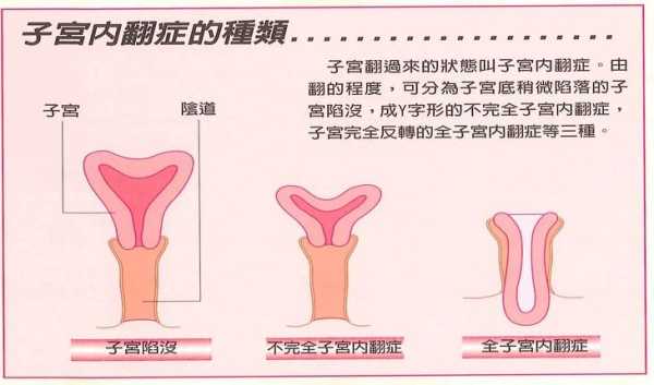 【子宫收缩不好的症状有哪些】,孕中期同房子宫收缩对胎儿有影响吗 第1张 【子宫收缩不好的症状有哪些】,孕中期同房子宫收缩对胎儿有影响吗 第1张