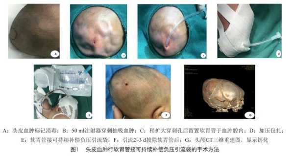 胎儿血肿(新生儿头皮血肿会引起黄疸高吗) 第1张 胎儿血肿(新生儿头皮血肿会引起黄疸高吗) 第1张