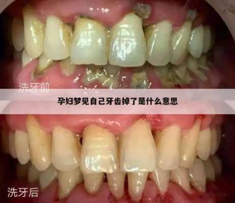 孕妇的的牙齿掉了怎么办,孕期掉牙齿有什么预兆  第3张