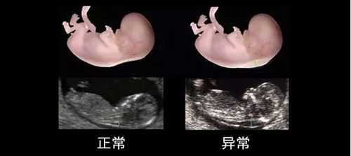 胎儿排畸形(胎儿排畸形在多少周) 第2张 胎儿排畸形(胎儿排畸形在多少周) 第2张