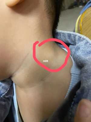 胎儿后颈部(宝宝切除扁桃体后耳朵下淋巴结肿大) 第3张 胎儿后颈部(宝宝切除扁桃体后耳朵下淋巴结肿大) 第3张