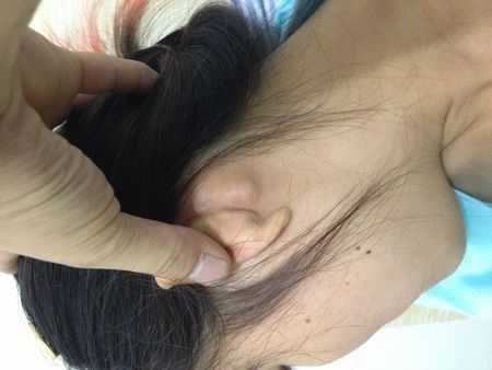 胎儿后颈部(宝宝切除扁桃体后耳朵下淋巴结肿大) 第2张 胎儿后颈部(宝宝切除扁桃体后耳朵下淋巴结肿大) 第2张