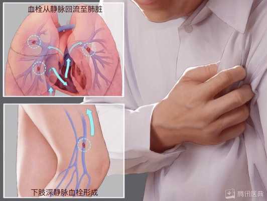 孕期肺栓塞(肺栓塞能治好吗?肺栓塞应该怎么治疗呢?会不会很严重呢) 第2张 孕期肺栓塞(肺栓塞能治好吗?肺栓塞应该怎么治疗呢?会不会很严重呢) 第2张