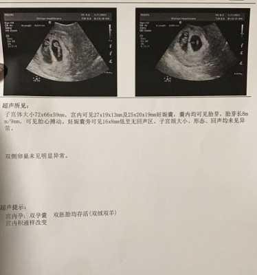 胎芽多大的时候出现胎心,胎儿胎心发育时间 第2张 胎芽多大的时候出现胎心,胎儿胎心发育时间 第2张