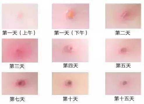 孕妇三个月了起水痘发烧39度多怎么办,孕期得水痘对胎儿有什么影响 第1张 孕妇三个月了起水痘发烧39度多怎么办,孕期得水痘对胎儿有什么影响 第1张