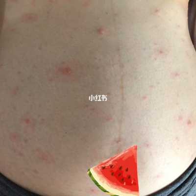 孕妇三个月了起水痘发烧39度多怎么办,孕期得水痘对胎儿有什么影响 第2张 孕妇三个月了起水痘发烧39度多怎么办,孕期得水痘对胎儿有什么影响 第2张