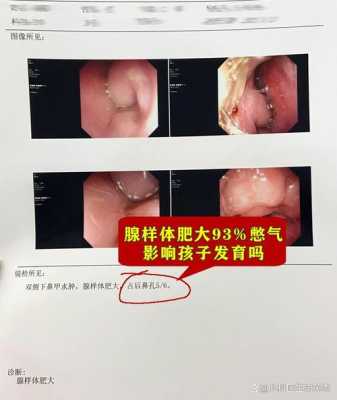 孕妇鼻炎对胎儿的影响(孕妇鼻炎对胎儿的影响大吗) 第3张 孕妇鼻炎对胎儿的影响(孕妇鼻炎对胎儿的影响大吗) 第3张