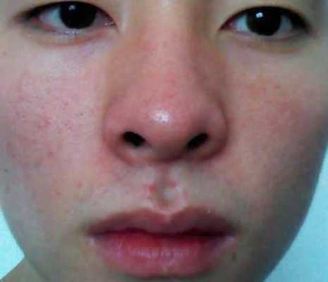 孕期鼻子红(孕期鼻子红是什么原因) 第1张 孕期鼻子红(孕期鼻子红是什么原因) 第1张