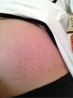 怀孕外阴瘙痒影响胎儿 第2张 怀孕外阴瘙痒影响胎儿 第2张