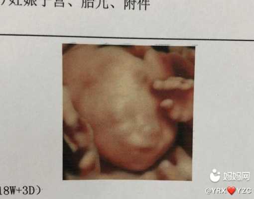 怀孕18周胎儿彩超(怀孕18周胎儿彩超图片) 第2张 怀孕18周胎儿彩超(怀孕18周胎儿彩超图片) 第2张