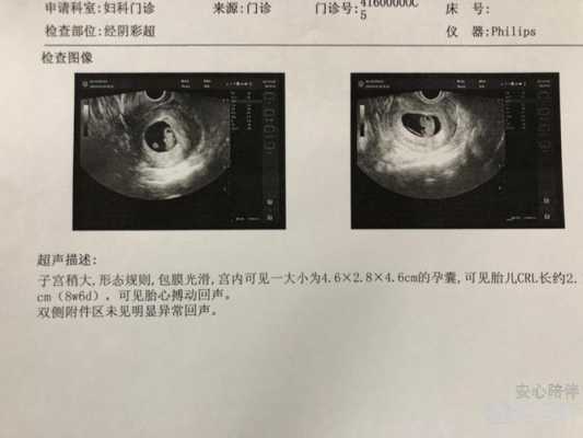 怀孕10周胎芽应该多大,胎芽多少cm变成胎儿 第2张 怀孕10周胎芽应该多大,胎芽多少cm变成胎儿 第2张