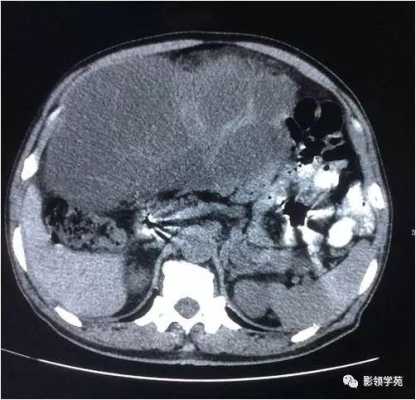 胎儿囊性占位(请问肝囊性占位病变,是什么意思) 第2张 胎儿囊性占位(请问肝囊性占位病变,是什么意思) 第2张