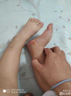 为什么孩子的脚比同龄人的脚偏大了这么多,胎儿手脚畸形的原因有哪些 第1张 为什么孩子的脚比同龄人的脚偏大了这么多,胎儿手脚畸形的原因有哪些 第1张