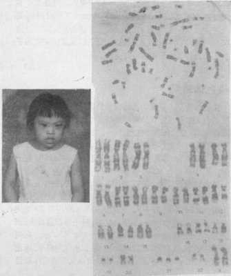胎儿染色体畸形(胎儿染色体畸形是什么原因) 第2张 胎儿染色体畸形(胎儿染色体畸形是什么原因) 第2张