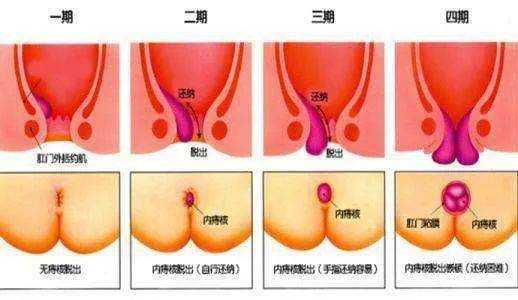 孕期肛门出血怎么办(孕期肛门出血怎么办?) 第1张 孕期肛门出血怎么办(孕期肛门出血怎么办?) 第1张