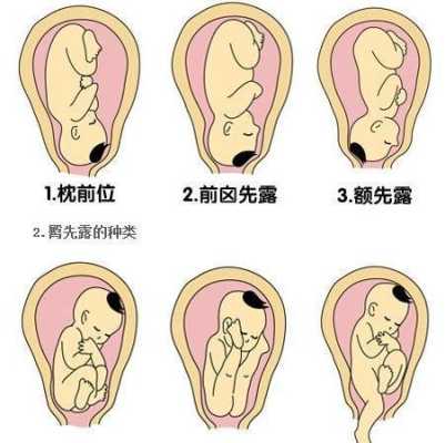 胎位右枕前是什么意思呢,胎儿右枕前位图片示意图 第2张 胎位右枕前是什么意思呢,胎儿右枕前位图片示意图 第2张