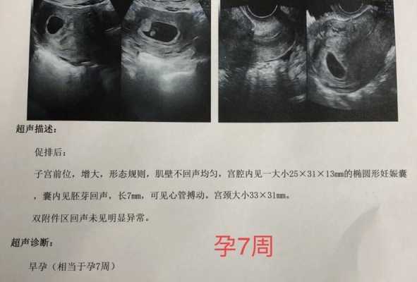胎囊里面是胎儿吗(孕囊的读音) 第3张 胎囊里面是胎儿吗(孕囊的读音) 第3张
