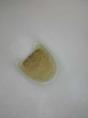 孕期尿蛋白一个加号(从怀孕33周到38周一直尿蛋白1+) 第3张 孕期尿蛋白一个加号(从怀孕33周到38周一直尿蛋白1+) 第3张