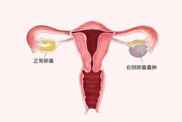 卵巢囊肿对胎儿有影响吗(怀孕了有卵巢囊肿对胎儿有影响吗) 第2张 卵巢囊肿对胎儿有影响吗(怀孕了有卵巢囊肿对胎儿有影响吗) 第2张