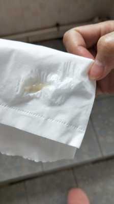 孕中期白带多正常吗, 第2张 孕中期白带多正常吗, 第2张