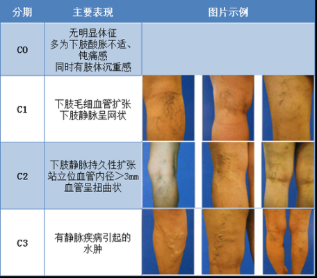 孕期腿部静脉曲张怎么办(孕期静脉曲张能顺产吗) 第1张 孕期腿部静脉曲张怎么办(孕期静脉曲张能顺产吗) 第1张