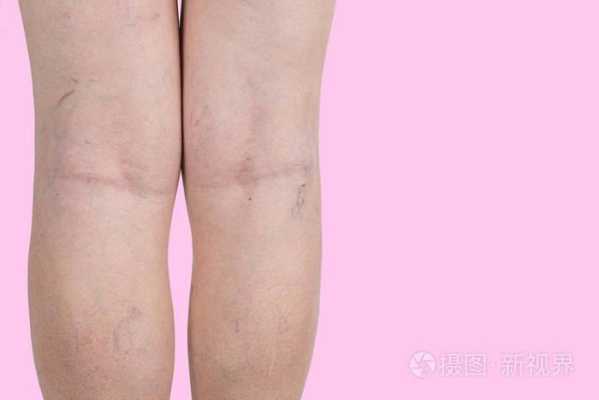孕期腿部静脉曲张怎么办(孕期静脉曲张能顺产吗) 第2张 孕期腿部静脉曲张怎么办(孕期静脉曲张能顺产吗) 第2张