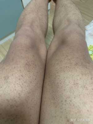 给鸡吃了感冒药.鸡生的蛋孕妇能吃吗,孕期鸡皮肤更严重了 第2张 给鸡吃了感冒药.鸡生的蛋孕妇能吃吗,孕期鸡皮肤更严重了 第2张