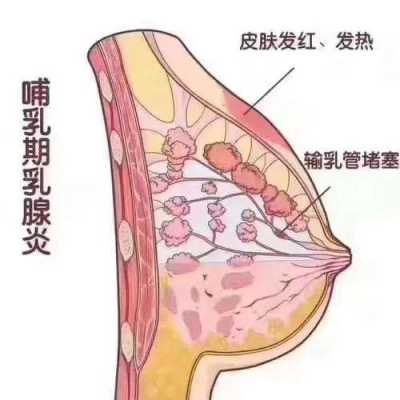 产妇乳腺管堵塞怎么办,孕期乳腺管堵塞 第3张 产妇乳腺管堵塞怎么办,孕期乳腺管堵塞 第3张