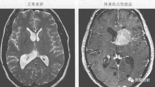 胎儿脑室不对称(胎儿脑室不对称有什么影响) 第1张 胎儿脑室不对称(胎儿脑室不对称有什么影响) 第1张