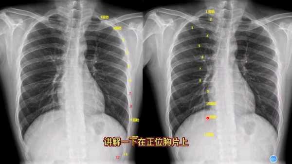 胸片对胎儿的影响（产后可以拍胸片吗）  第1张
