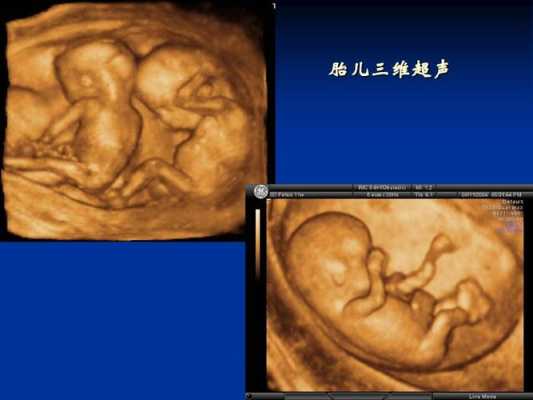 三维成像是检查什么,胎儿三维检查主要检查什么 第2张 三维成像是检查什么,胎儿三维检查主要检查什么 第2张