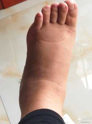 孕期手肿痛(孕晚期睡醒后手浮肿是怎么回事呢?我确定我没压到手,怎么办呢) 第2张 孕期手肿痛(孕晚期睡醒后手浮肿是怎么回事呢?我确定我没压到手,怎么办呢) 第2张