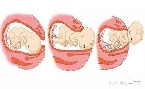 孕期漏胎(浮胎是什么意思) 第2张 孕期漏胎(浮胎是什么意思) 第2张