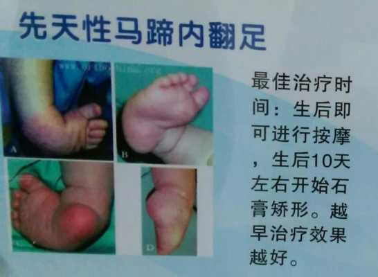 胎儿左足内翻怎么办(新生儿轻微脚内翻是怎么回事呢) 第2张 胎儿左足内翻怎么办(新生儿轻微脚内翻是怎么回事呢) 第2张