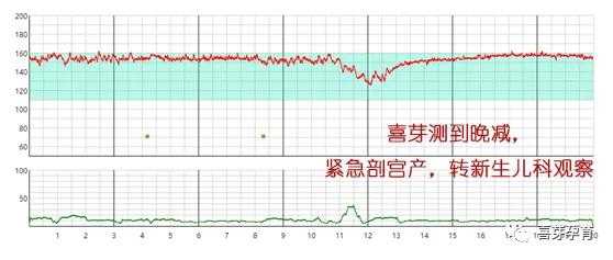 孕晚期宫缩胎儿会缺氧吗(宫缩的时候胎心会加快吗?宫缩胎儿会有什么反应呢) 第2张 孕晚期宫缩胎儿会缺氧吗(宫缩的时候胎心会加快吗?宫缩胎儿会有什么反应呢) 第2张