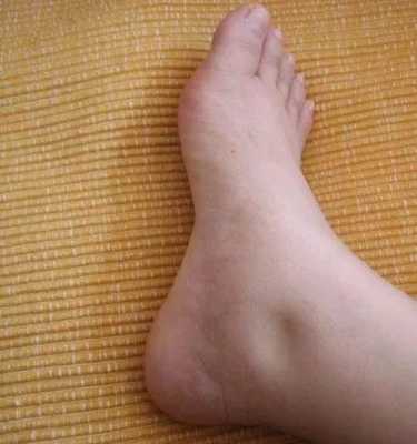 孕妇水肿是怎么回事,孕期水肿表现有哪些 第1张 孕妇水肿是怎么回事,孕期水肿表现有哪些 第1张