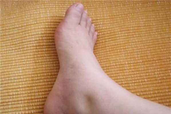 孕妇水肿是怎么回事,孕期水肿表现有哪些 第3张 孕妇水肿是怎么回事,孕期水肿表现有哪些 第3张