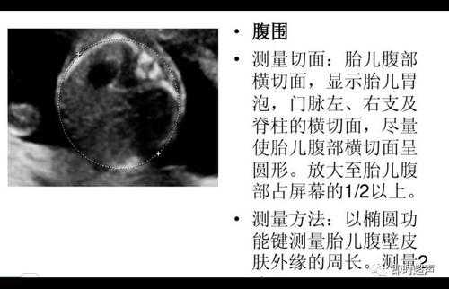 胎儿超声切面(NT超声孕龄13W+1d是什么意思) 第2张 胎儿超声切面(NT超声孕龄13W+1d是什么意思) 第2张