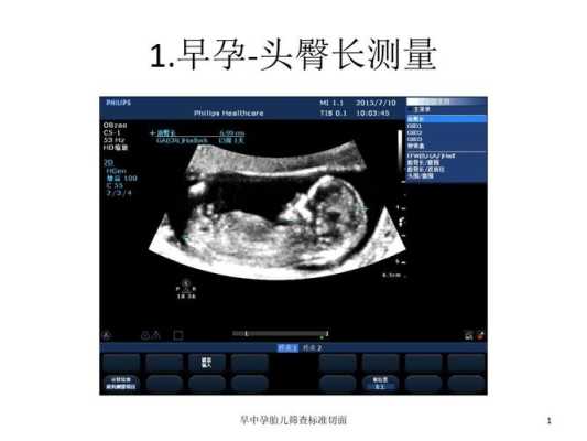 胎儿超声切面(NT超声孕龄13W+1d是什么意思) 第1张 胎儿超声切面(NT超声孕龄13W+1d是什么意思) 第1张