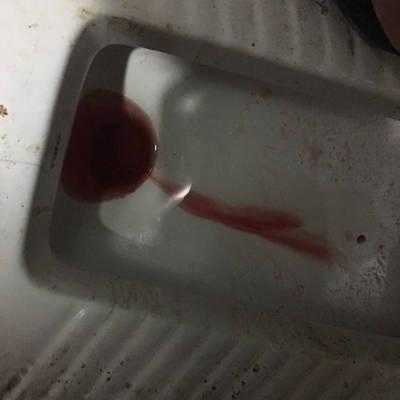 孕期尿潜血2(孕期尿潜血2) 第2张 孕期尿潜血2(孕期尿潜血2) 第2张