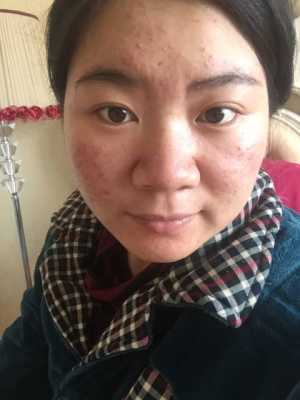 怀孕期间脸上长痘痘该怎么办,怀孕期间粉刺多怎么处理  第3张