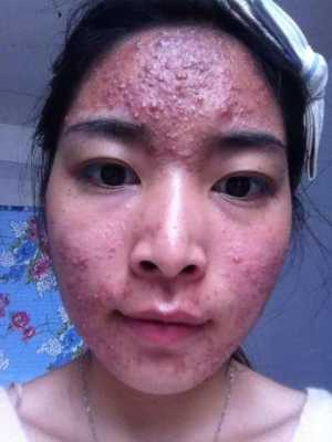 孕期痤疮怎么办(孕妇脸上长痘痘怎么调理?快四个月了,需要使用药物的吗) 第3张 孕期痤疮怎么办(孕妇脸上长痘痘怎么调理?快四个月了,需要使用药物的吗) 第3张