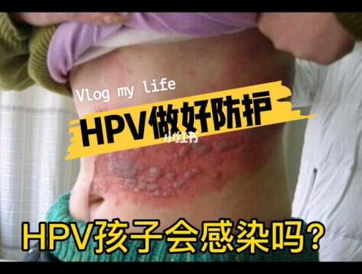 感染hpv病毒的患者生小孩会传染给小孩吗,母亲hpv感染对胎儿的影响 第2张 感染hpv病毒的患者生小孩会传染给小孩吗,母亲hpv感染对胎儿的影响 第2张