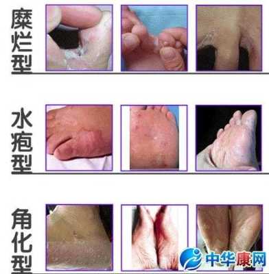 孕妇脚气对胎儿有影响吗(孕妇脚气对胎儿有影响吗图片) 第2张 孕妇脚气对胎儿有影响吗(孕妇脚气对胎儿有影响吗图片) 第2张