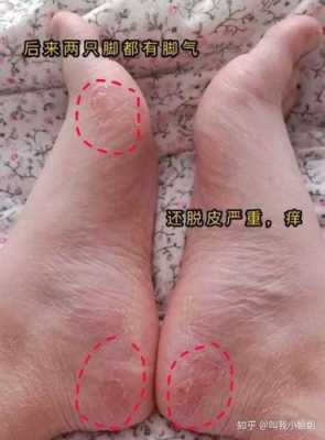 孕妇脚气对胎儿有影响吗(孕妇脚气对胎儿有影响吗图片) 第1张 孕妇脚气对胎儿有影响吗(孕妇脚气对胎儿有影响吗图片) 第1张