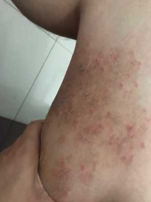 怀孕期间腿痒(怀孕期间腿痒怎么办特别是在晚上 越抓越痒) 第1张 怀孕期间腿痒(怀孕期间腿痒怎么办特别是在晚上 越抓越痒) 第1张